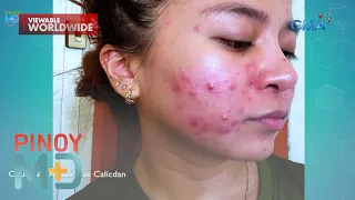 Pangarap na clear skin, nauwi sa pagkakaroon ng namamagang pimples?! | Pinoy MD