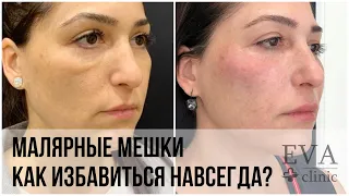 МАЛЯРНЫЕ МЕШКИ. КАК ИЗБАВИТЬСЯ?