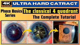 Ultra hard cataract : Demonstrating the 4 QUADRANT TECHNIQUE (Phaco Basics) - Dr. Deepak Megur