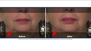 Reducing fine lines and wrinkles with Plexaderm