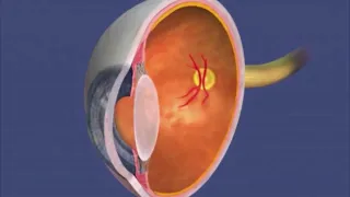 (Audio Description) Animation: Retinopathy of Prematurity