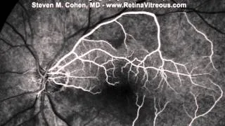 Central Retinal Artery Occlusion with Cilioretinal Artery Sparing - Fluorescein Angiogram Video