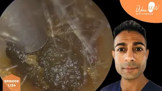 1,124 - Deeply Impacted & Blocked Ear Wax Removal