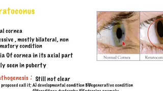 KERATOCONUS|Corneal Diseases|UG Medical Ophthalmology|Medical ABC