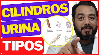 Cilindros na urina: quais os tipos? | Sedimentoscopia | Exame de urina tipo 1 | Urinálise | EAS