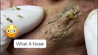 WHAT A NOSE ? IT'S FULL OF BLACKHEADS