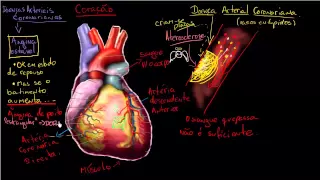O que é Doença arterial coronariana