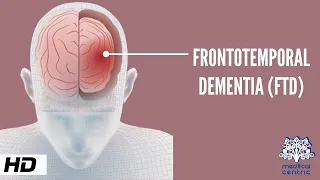 Frontotemporal Dementia, Causes, Signs and Symptoms, Diagnosis and Treatment.