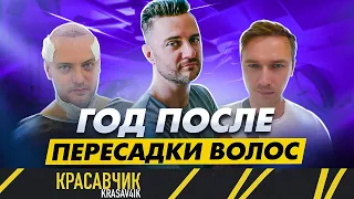 Result one year after hair transplant | How your life can change | KRASAV4IK / OLEG VALYN