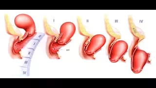Опущение матки и влагалища  лечение остеопатией