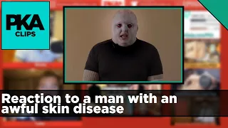 Reaction to a man with an awful skin disease - PKA Clip