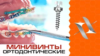ALL about orthodontic MINI-SCREWS and braces