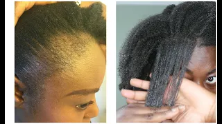 Is Traction Alopecia Reversible.