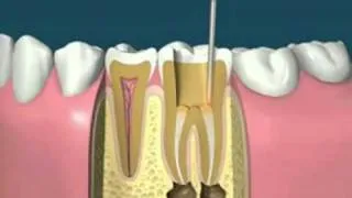 Precious Dental on Root Canal Treatment