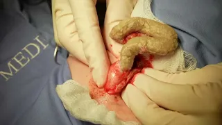 20 year old CYST!