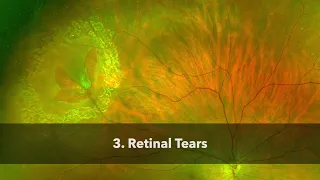 3. Retinal Tears