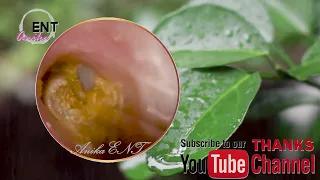 AnikaENT | EAR WAX REMOVAL - EARWAX IS DIFFICULT TO REMOVE #243