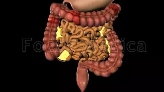 Crohn's disease - Animated Atlas