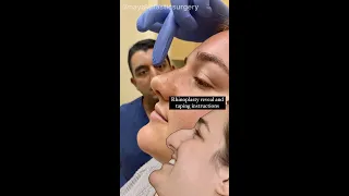 Rhinoplasty reveal, taping, and massage!