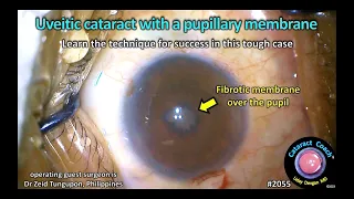 CataractCoach™ 2055: uveitic cataract with pupillary membrane