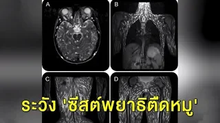 ศูนย์วิจัยโรคปรสิต เผยกินผักสดต้องระวัง 'ซีสต์พยาธิตืดหมู' หลังพบกระจายเต็มตัวคนไข้