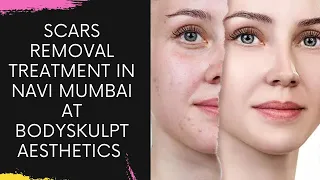 SCARS REMOVAL TREATMENT IN NAVI MUMBAI AT BODYSKULPT AESTHETICS #Shorts #ytshorts