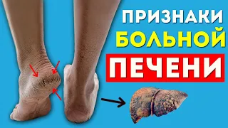 11 РАННИХ признаков ПРОБЛЕМ с ПЕЧЕНЬЮ: не игнорируйте их! | Как понять, что ваша печень отмирает?