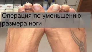 Операция по уменьшению размера ноги