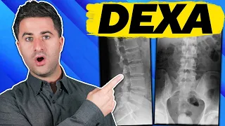 3 things you MUST KNOW about your DEXA scan