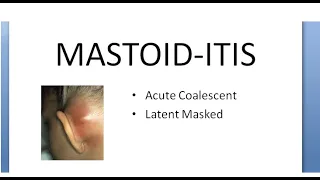 ENT Mastoiditis What is Mastoid Inflammation Infection Acute Coalescent Pain behind ear
