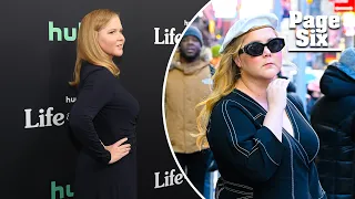 Amy Schumer says 'puffier' face is due to autoimmune disease, endometriosis