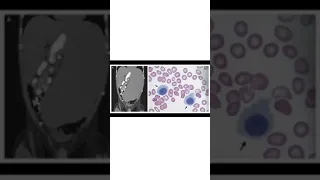 Hairy Cell Leukemia [USMLE Brief Review]    #shorts