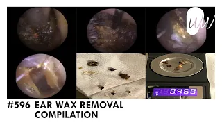 596 - Ear Wax Removal Compilation