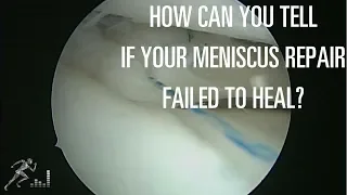 How can you tell if your meniscus repair didn't heal?