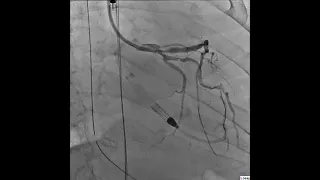 Coronary Angiogram Performed post-S-IVL Resulted in Lesion Modification