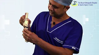 PCL Ligament Injury in Hindi (PCL लिगामेंट टूटने पर क्या करें?)