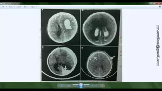 شرح الأشعة المقطعية على الرأس CT scan, Head د. محمود سويلم