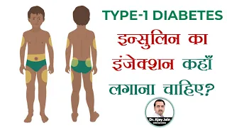 इन्सुलिन का इंजेक्शन कहाँ लगाना चाहिए? | Insulin Injection Sites | Type-1 Diabetes