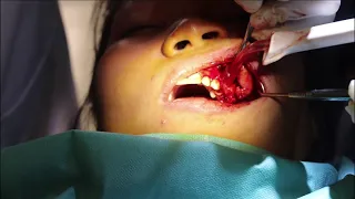 Surgical Removal of Ossifying Fibroma