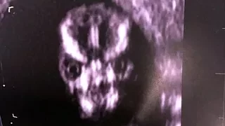 Woman’s Baby Looks Like The DEVIL In Scary Ultrasound