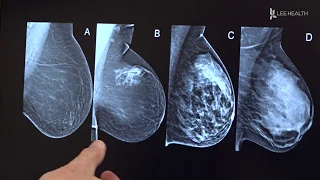 New Guidelines for Mammograms