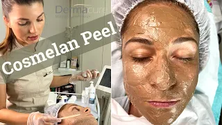COSMELAN PEEL- THE NUMBER ONE PEEL FOR PIGMENTATION, MELASMA, SUN DAMAGE, ACNE, AND ACNE SCARRING