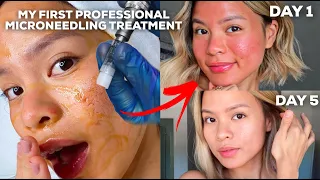 1-5 DAY HEALING POST PROFESSIONAL MICRONEEDLING + GIVEAWAY
