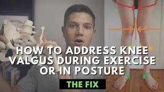 How to Address Knee Valgus During Exercise or In Posture - The Fix