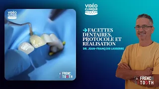 Facettes dentaires, protocole & réalisation - Dr Lasserre