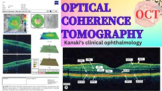 Optical Coherence Tomography (OCT)-Kanski's clinical ophthalmology #macula #kanski #ophthalmology