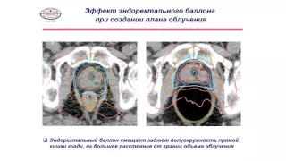Лучевая терапия предстательной железы Усычкин С. В.
