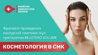 Контурная пластика скул препаратом Belotero Volume