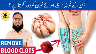 Lahsun Ke Fayde - Remove Blood Clots in Legs - Garlic Benefits - Urdu/Hindi - Dr. Ibrahim
