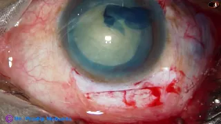 Learn SICS : Be a "Comprehensive" cataract Surgeon, Pradip Mohanta, 23rd June, 2020